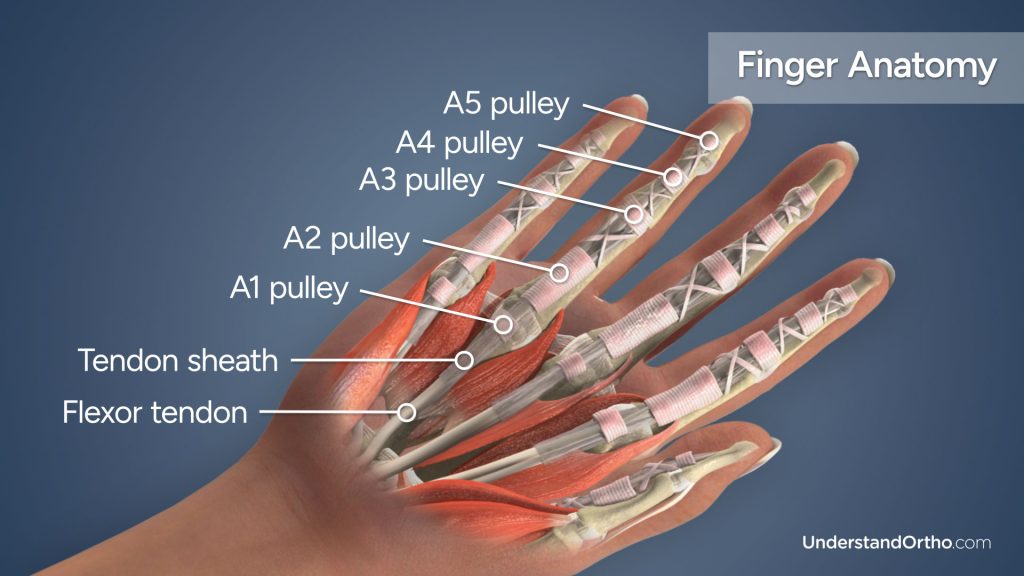 A1 Pulley Acupuncture