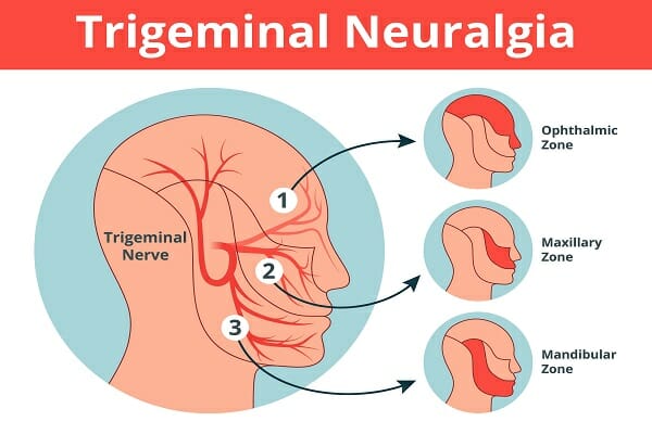 Trigeminal Neuralgia