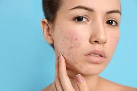 acne acupuncture