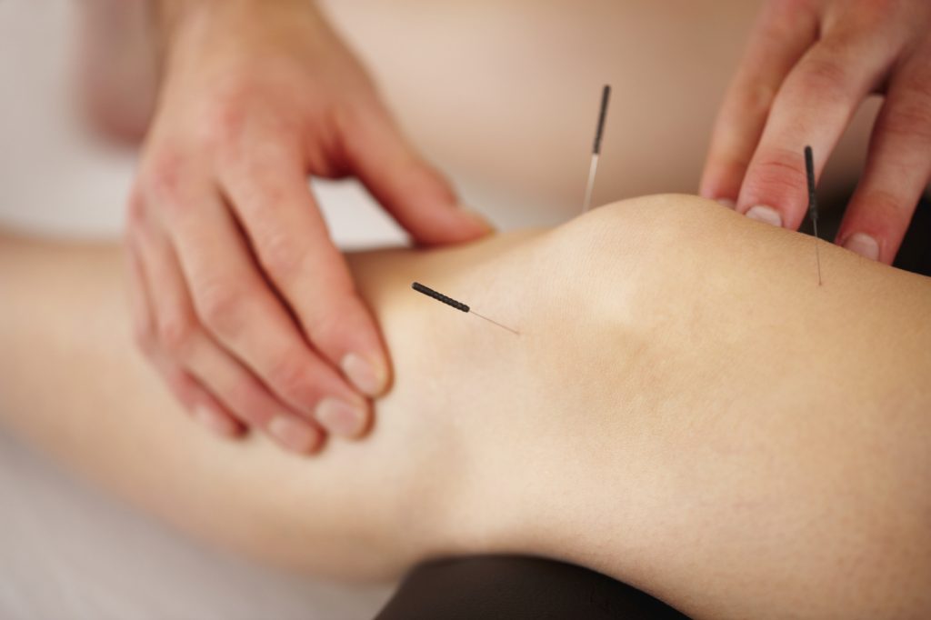 acupuncture near me